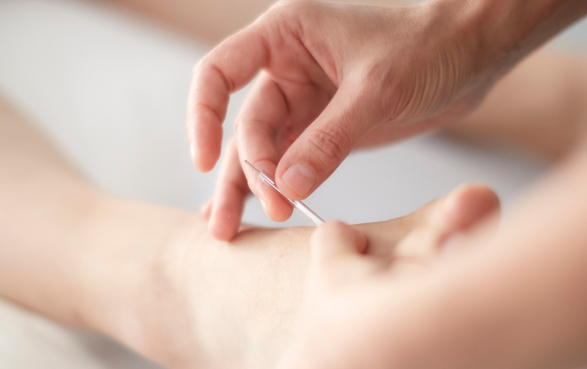 A practitioner carefully performs acupuncture on a patient's foot.