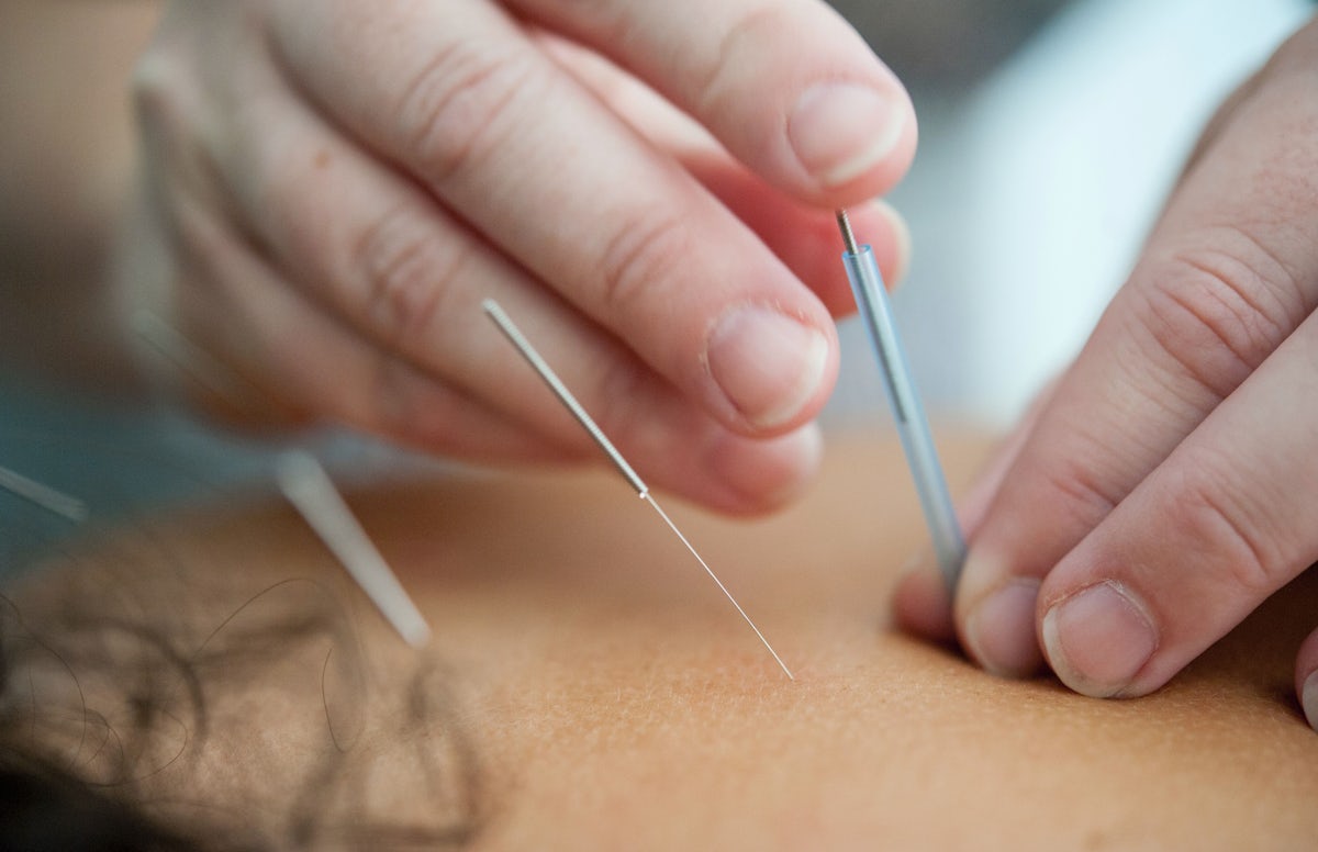 Life as an Acupuncturist vs Other Alternative Healthcare Modalities